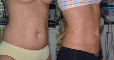 Laser Liposuction before and after pictures of female