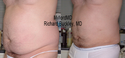 Laser Liposuction. Free Consultation. Call now - 570-296-4000