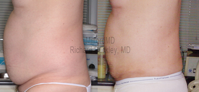 Male Laser Liposuction at MilfordMD Skin and Laser Center. Serving PA NJ and New York