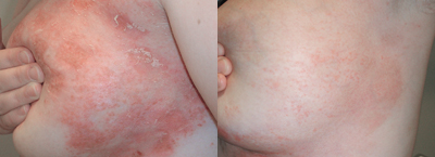 Treatment for Psoriasis of the breast for residents of PA, NJ and NY