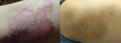 Treating Psoriasis with the Excimer Laser in Milford, New Jersey and Pennsylvania
