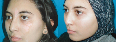 Treatment for Psoriasis on the face at Advanced Dermatology Milford