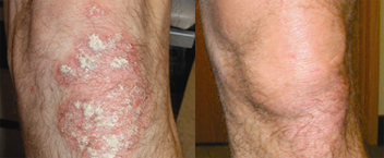 Treatment for Psoriasis of the Knee for residents of PA, NJ and NY