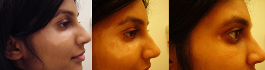 Treatment for Vitiligo at Advanced Dermatology Milford. Call us at 570-296-4000