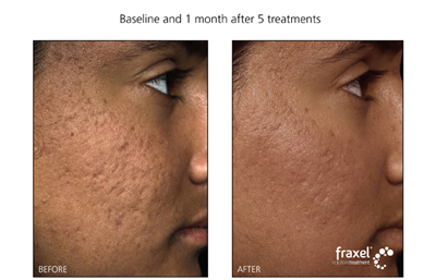 Fraxel Laser treatment for Acne Scarring