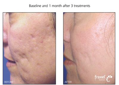 Fraxel Laser treatment for acne