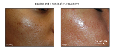 Fraxel laser Treatment for acne scarring at Advanced Dermatology Milford. Call now for more information. 570-296-4000