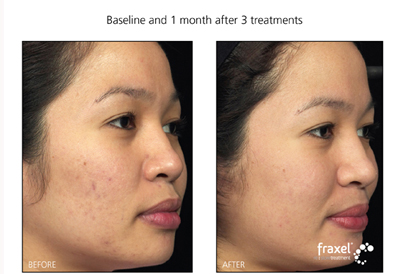Fraxel Laser Treatment for Acne