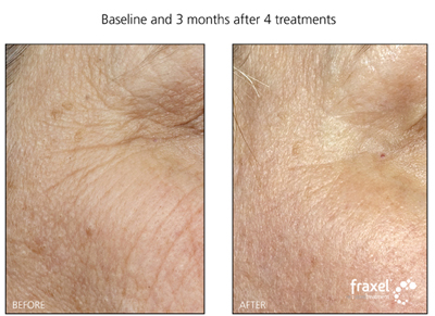 Fraxel Laser Treatment for facial wrinkles