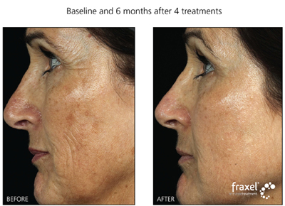 Laser Treatment for residents of PA, NJ and NY at Advanced Dermatology Milford. Located in Milford PA
