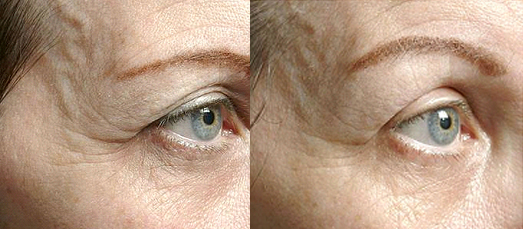 Blepharoplasty, Droopy Eyes, MilfordMD Skin and Laser Center. 570-296-4000