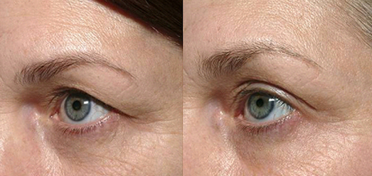 Droopy Eyes, Blepharoplasty, MilfordMD Skin and Laser Center. Serving the tri-state area. Pennsylvania (PA) New Jersey (NJ) New York (NY)